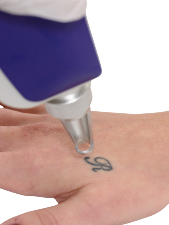 Newcastle NSW Tattoo Removal